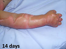 surrean-14 days after burn